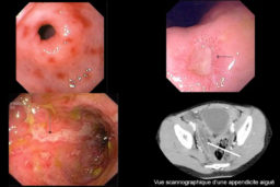 Maladies intestinales : Gastrite, Ulcère bulbaire, maladie de Crohn et appendicite aiguë