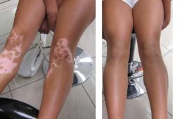 Vitiligo avant - après
