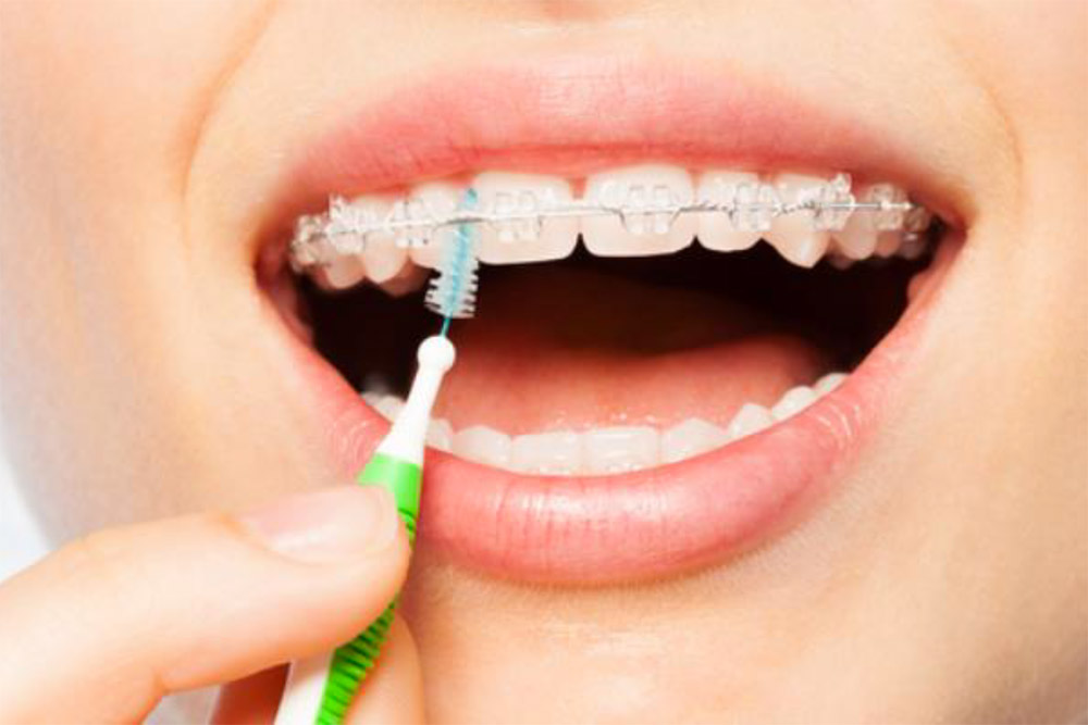 Les brossettes interdentaires sont à utiliser pour nettoyer les dents méme avec un appareil dentaire