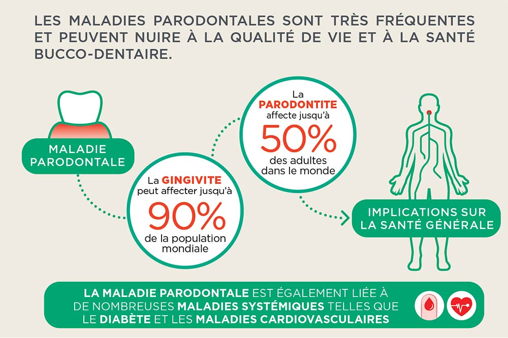 Maladies Parodontales - Elles sont dangereuses pour la santé