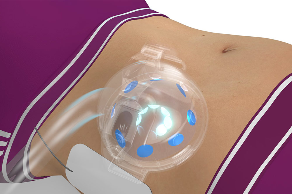 Slimiser - Des trains de micro-impulsionsstimulent la musculature periartériolaire afin d'augmenter le drainage circulatoire et d’accélérer l’évacuation naturelle des graisses libérées.