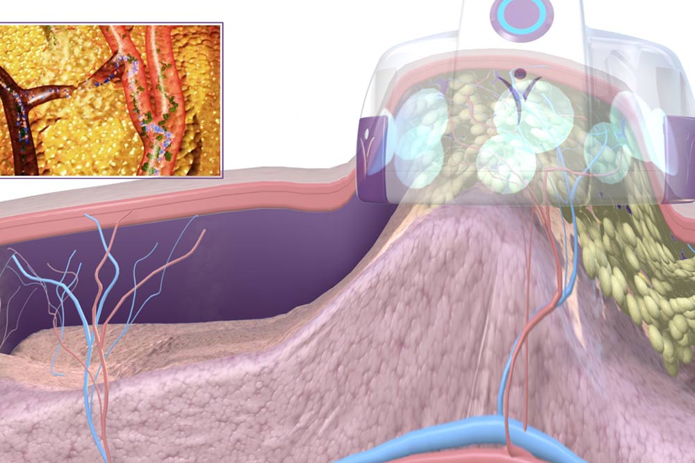 Les adipocytes (cellules graisseuses) sont compressés et étirés des millions de fois, ce qui rompt leur membrane et libère la graisse, qui est ensuite progressivement éliminée par voie naturelle