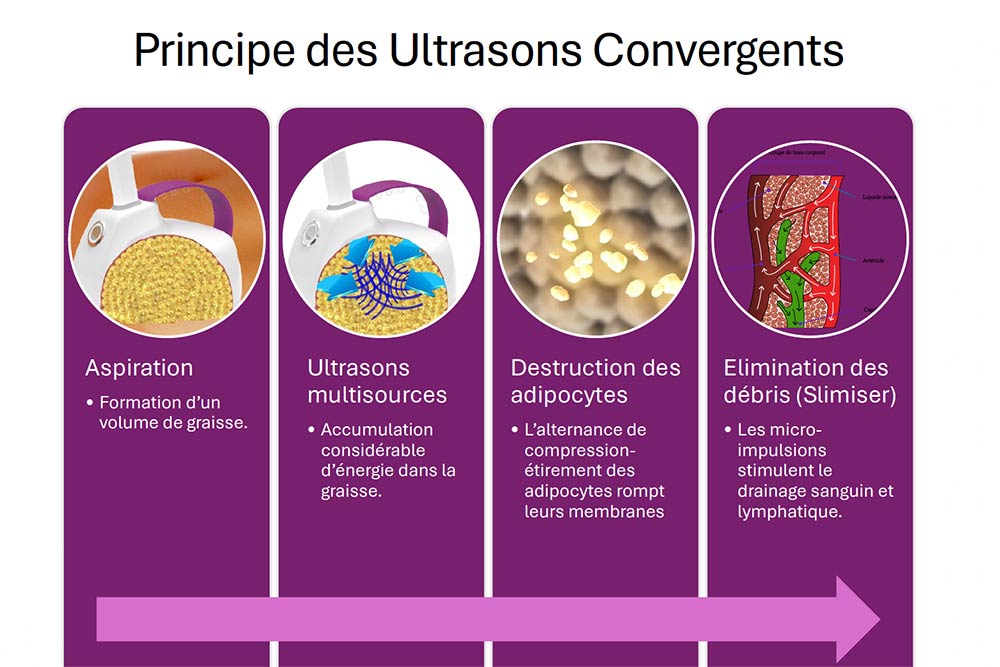 Slimiser - des Ultratons Convergents efficaces.